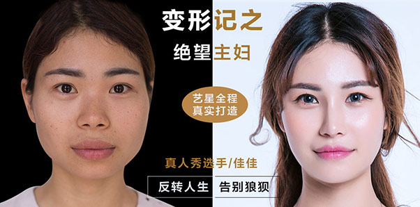 佳佳-隆鼻案例